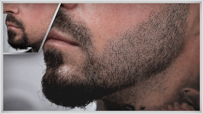 Beard scalp micropigmentation fills gaps in the beard