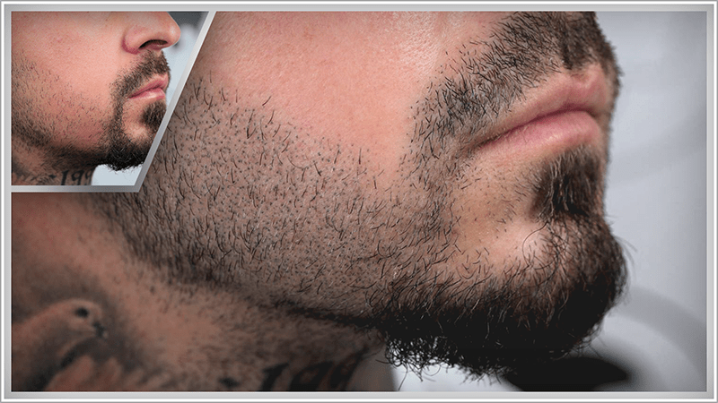 A beard thickening creates more density