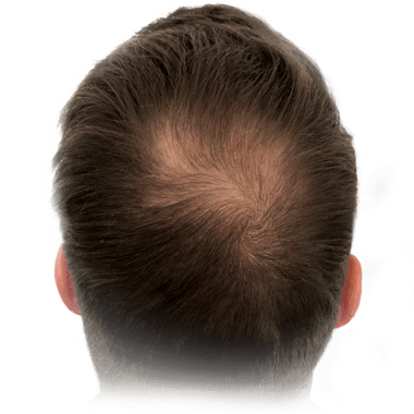 Hair thickening
